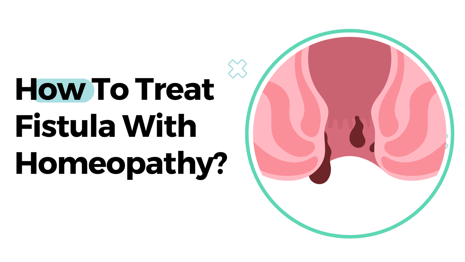How To Treat Fistula With Homeopathy?