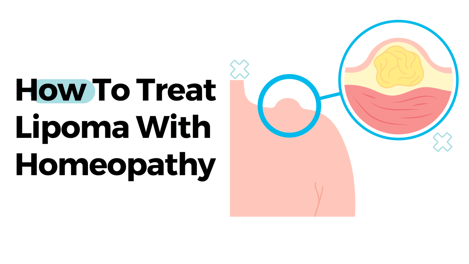How To Treat Lipoma With Homeopathy?