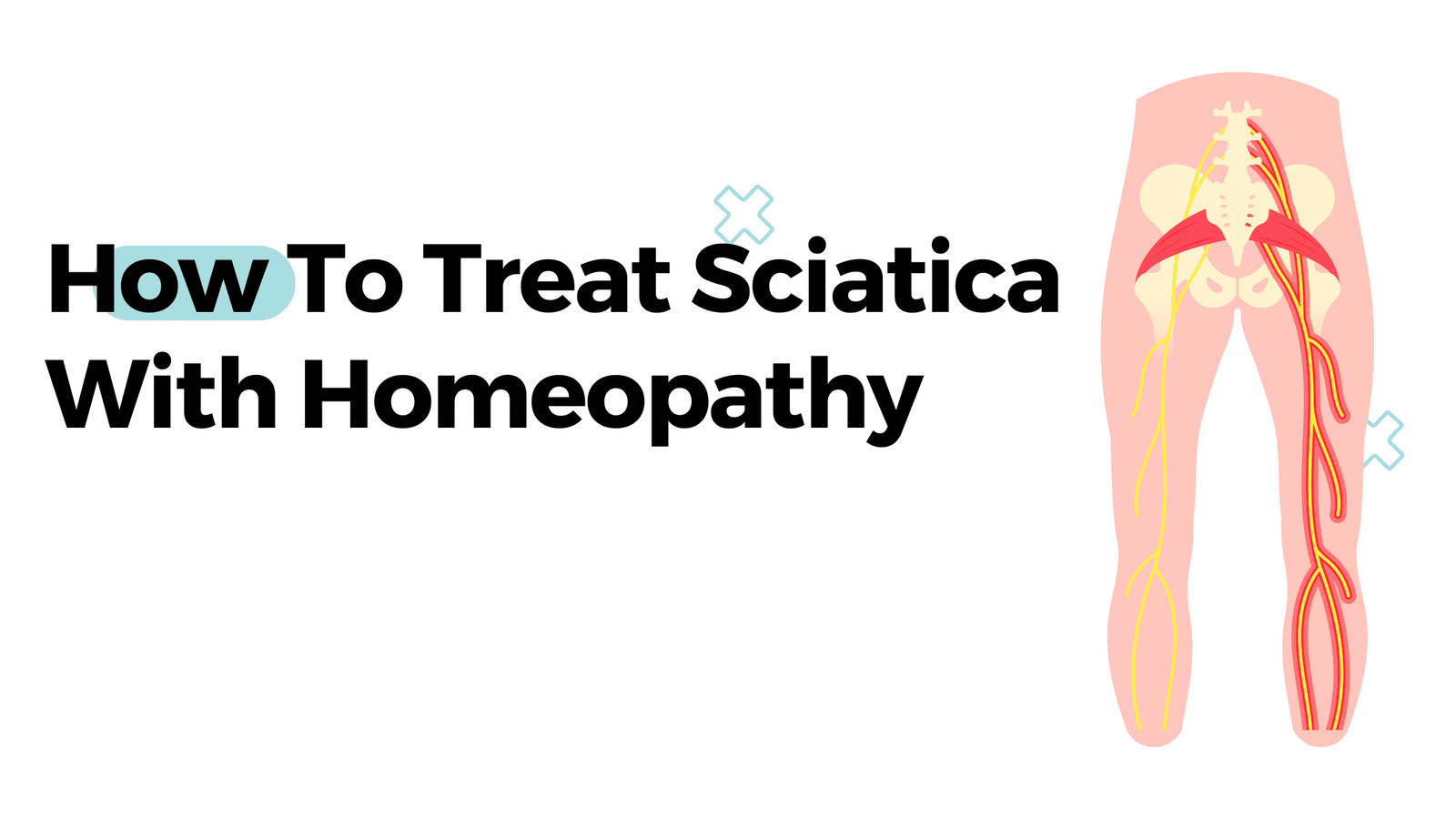 साइटिका का होम्योपैथिक इलाज कैसे करें? Homeopathy Treatment For Sciatica In Hindi