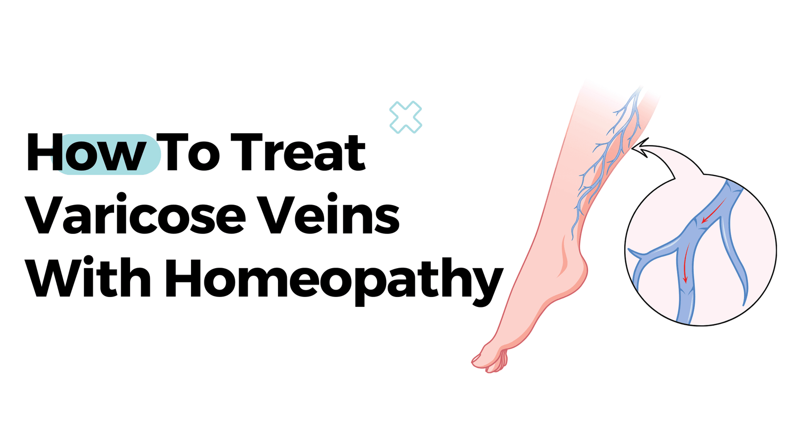 How To Treat Varicose Veins With Homeopathy?