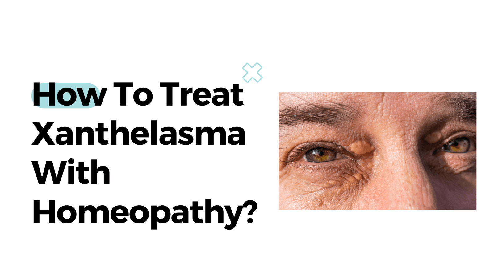 How To Treat Xanthelasma With Homeopathy?
