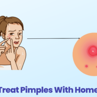 How To Treat Pimples With Homeopathy?
