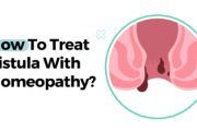 भगन्दर (फिस्टुला) का इलाज होम्योपैथी से कैसे करें? Fistula Treatment in Homeopathy in Hindi
