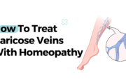 How To Treat Varicose Veins With Homeopathy?