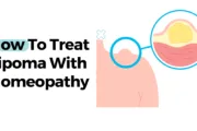 How To Treat Lipoma With Homeopathy? How To Treat Lipoma With Homeopathy?
