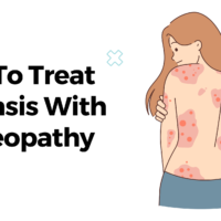 How To Treat Psoriasis With Homeopathy?