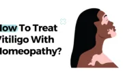 How To Treat Vitiligo With Homeopathy? How To Treat Vitiligo With Homeopathy?