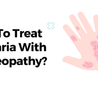 How To Treat Urticaria With Homeopathy?