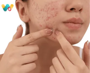 Whiteheads & Blackheads