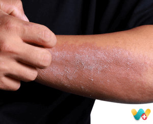 Eczema - खुज़ली की समस्या 