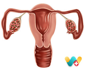 PCOS PCOD/ Cyst / Fibroid