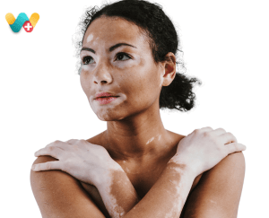 Vitiligo / Leucoderma - सफ़ेद दाग 